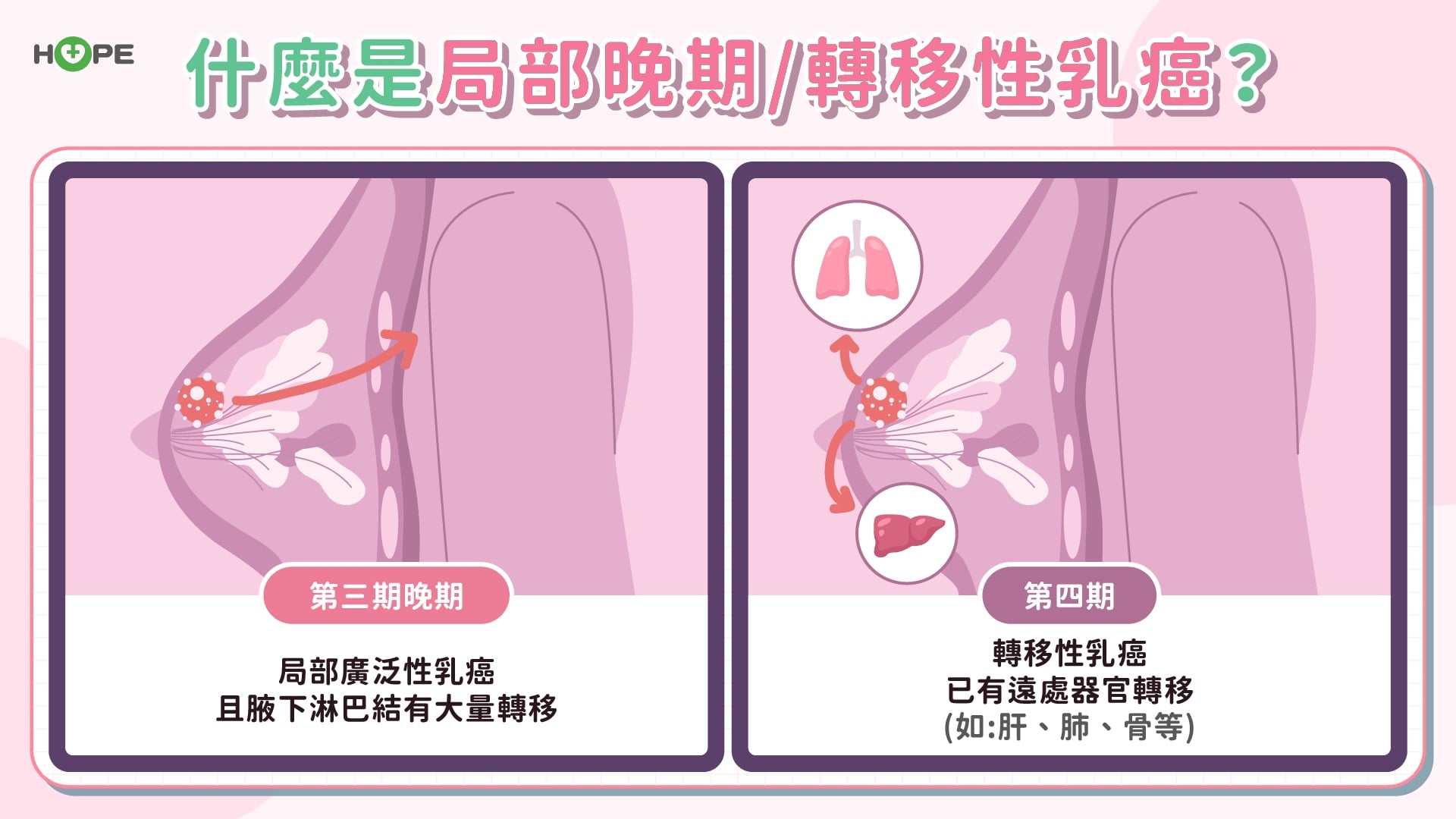 擊碎「最難踢鐵板」!ADC 藥物木馬屠城 轉移性乳癌迎來生存曙光
