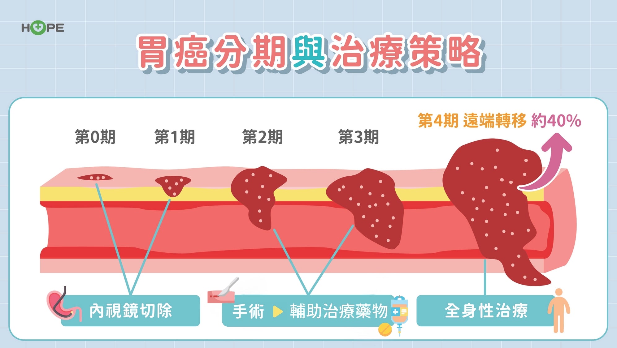 胃癌一定要全切?「圍手術期治療」新趨勢:提升存活率 更有機會保住胃功能