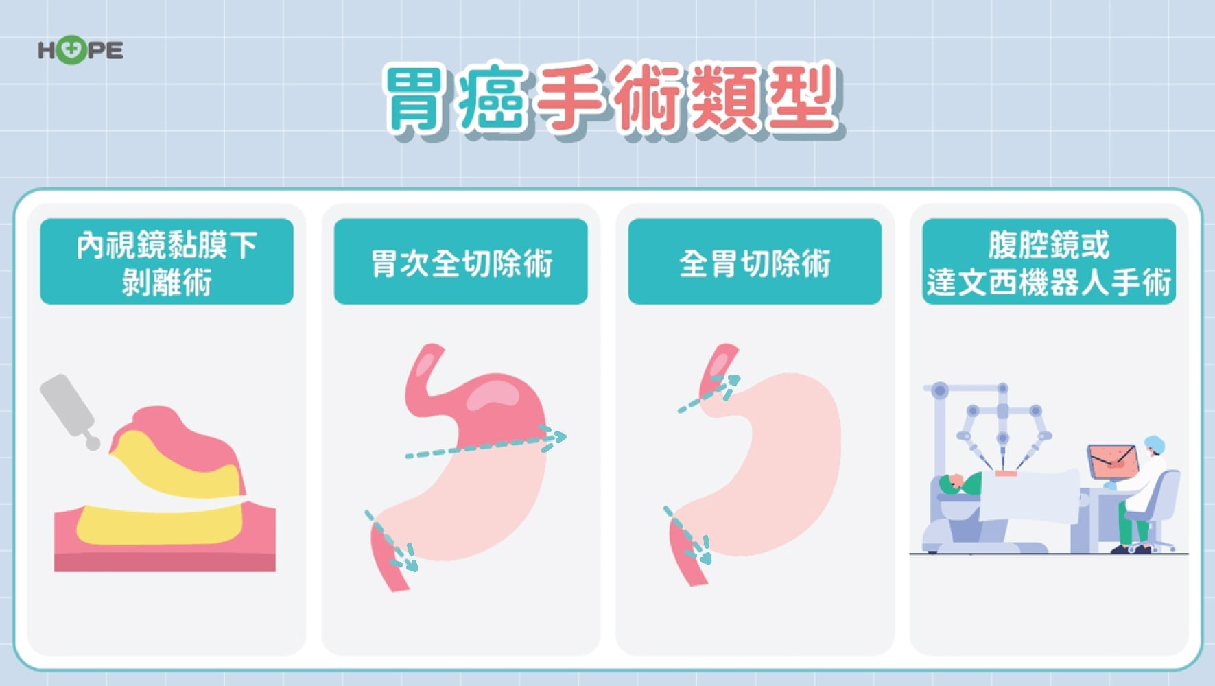 胃癌一定要全切?「圍手術期治療」新趨勢:提升存活率 更有機會保住胃功能
