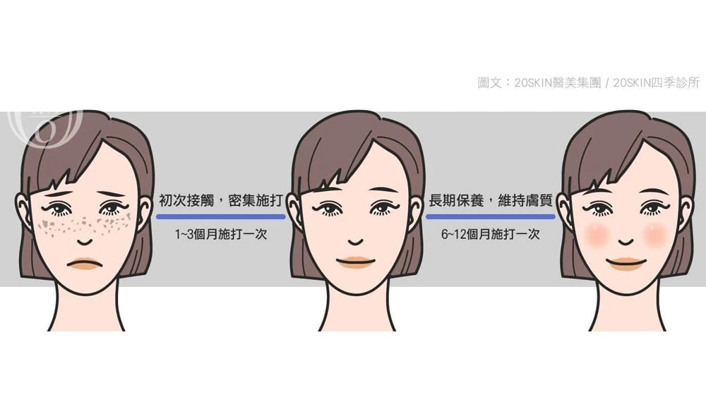 皮秒雷射要做幾次才有效？恢復期多久、會痛嗎？ 