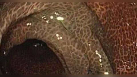 喝通便茶10年！中國女連5天拉不出送醫　慘變「豹紋腸」切30cm保命