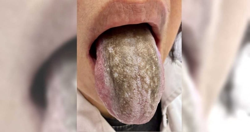 1名婦人因罹患牙周病，過度使用強效漱口水清潔口腔，反而導致舌頭變黑並出現灼熱感。（圖／翻攝自臉書，柳雱邁小兒科）