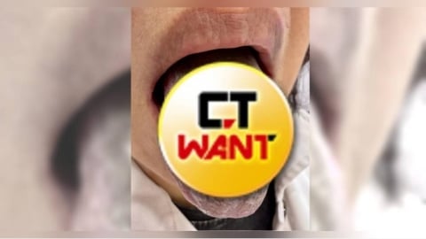 罹牙周病狂灌漱口水！每天6次慘變「黑舌」整條毛茸茸　畫面超驚悚