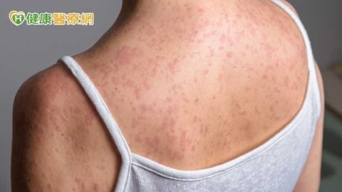 麻疹移入增2例！北部5旬女「無紅疹」併發腦炎住加護　疾管署這麼說