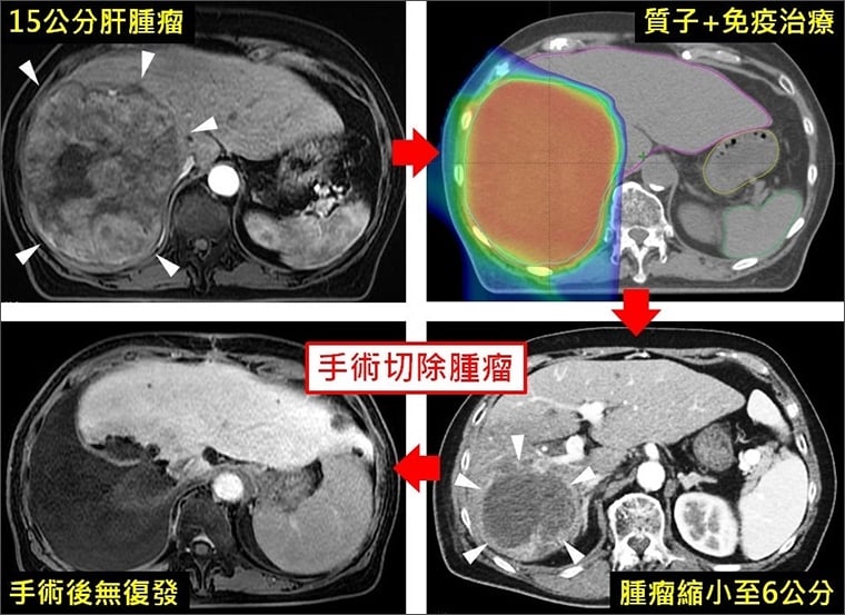 質子放射合併免疫治療抗肝癌 長庚研究登國際頂尖期刊