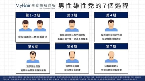 雄性禿分期如何判斷？醫師解析常見落髮階段與評估重點