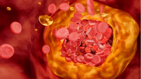 高血脂無聲卻致命！每3位台人就有1人罹病？ 醫曝「1治療利器」越快介入越好