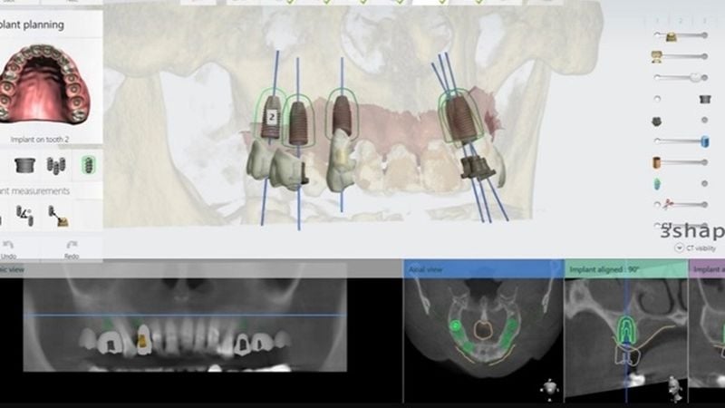 植牙不只是種牙根！「2關鍵」提升自然外觀與功能