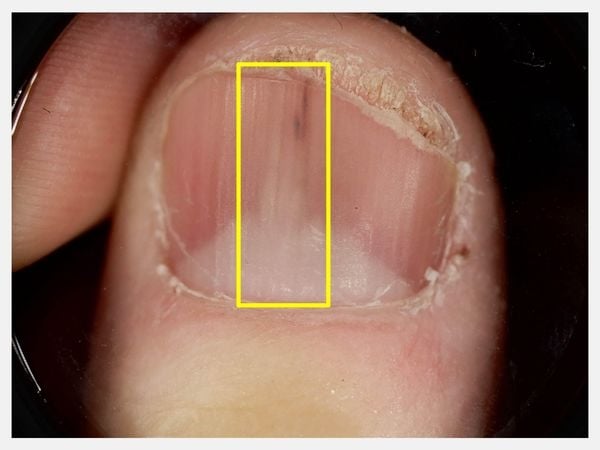 指甲不平整、直條紋現蹤？醫揭「甲下腫瘤警訊」