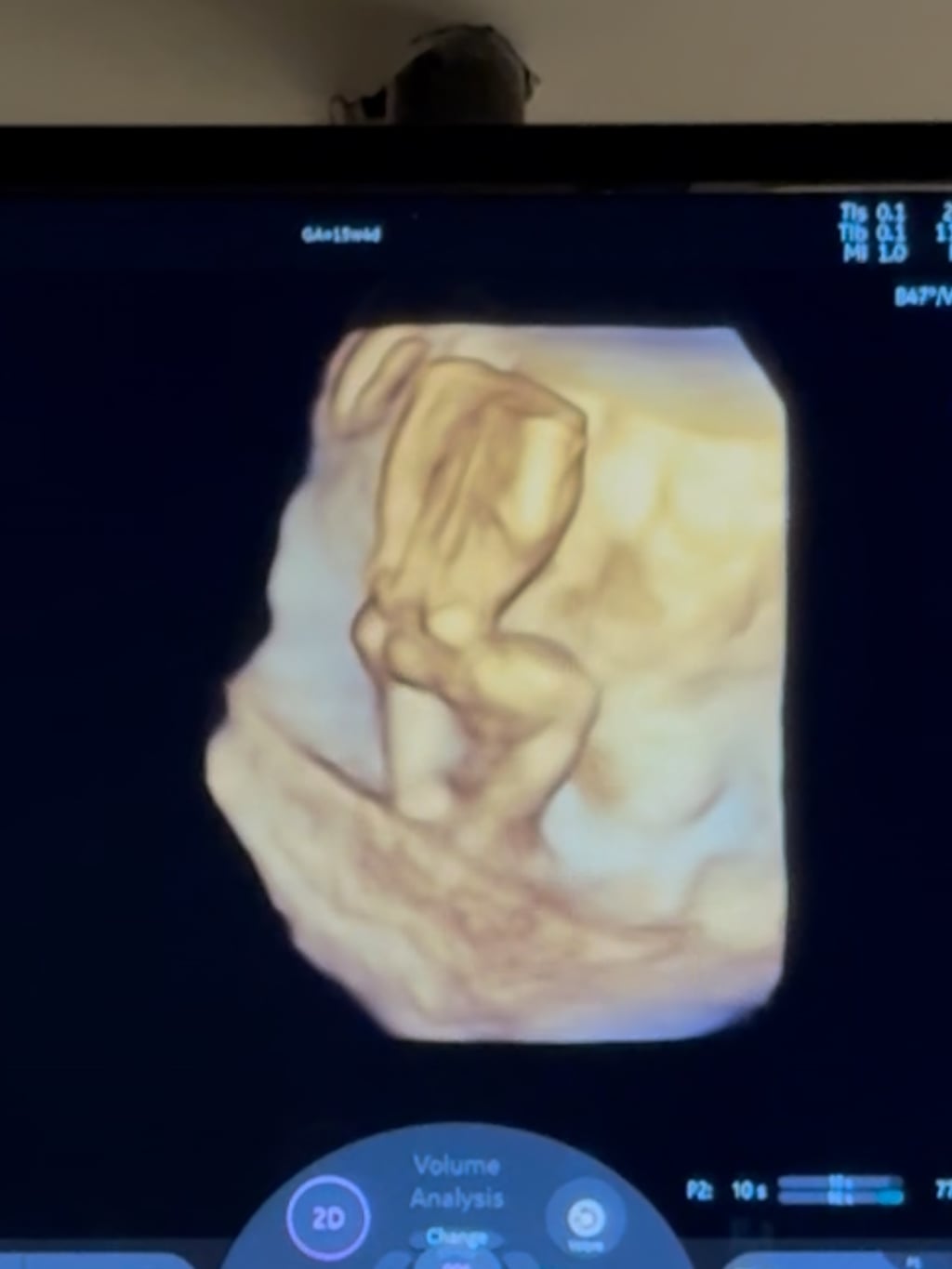 才宣布懷男寶!李又汝做完羊膜穿刺「性別大翻盤」驚喊:變女兒了