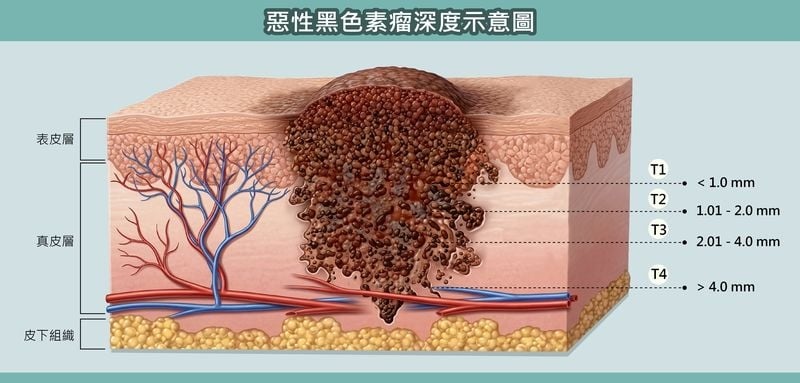腳趾紅腫以為甲溝炎！七旬婦確診黑色素癌第二期　醫揭警訊