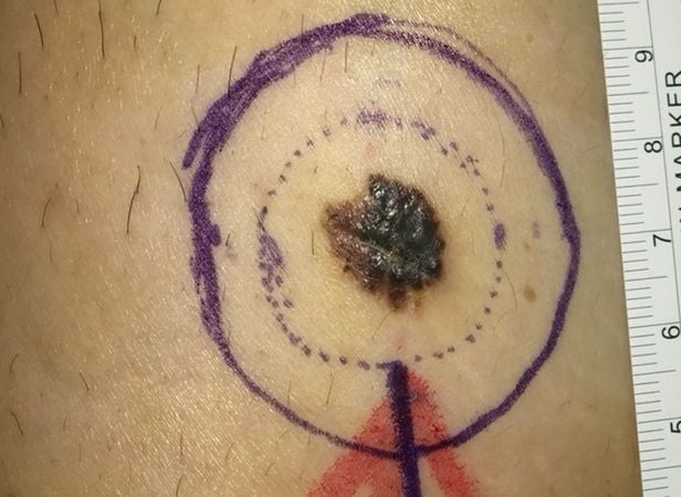 腳趾紅腫以為甲溝炎！七旬婦確診黑色素癌第二期　醫揭警訊