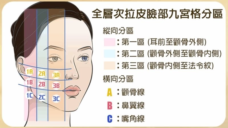 拉皮手術怎麼選？全層次拉皮從皮膚到筋膜　層層剝離助改善臉部鬆弛下垂
