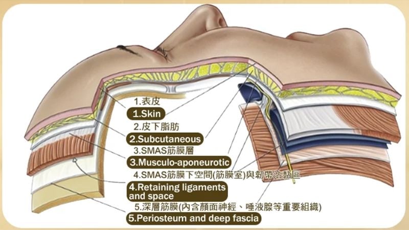拉皮手術怎麼選？全層次拉皮從皮膚到筋膜　層層剝離助改善臉部鬆弛下垂