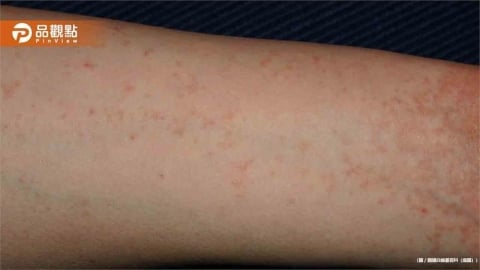 32歲女子全家「夜夜癢醒」醫師曝恐怖傳染真相