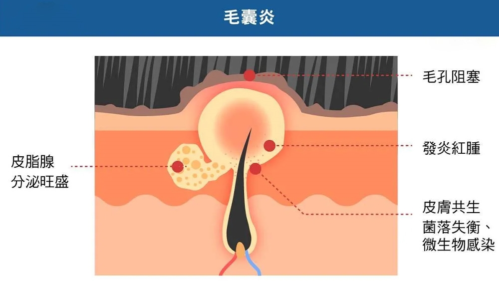 頭皮反覆出現狀況？認識毛囊炎與落髮相關性及日常頭皮照護方式