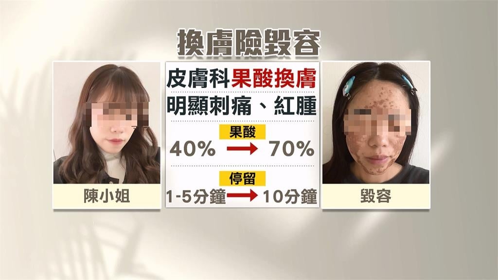 換膚變毀容!美容師疑誤拿高濃度果酸 女臉部大面積灼傷