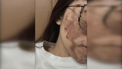 換膚變毀容!美容師疑誤拿高濃度果酸 女臉部大面積灼傷