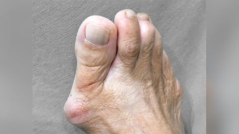 拇指外翻怎根治？關鍵在於嚴重程度！醫師一次解析：常見「5症狀」、「2種」治療方式！