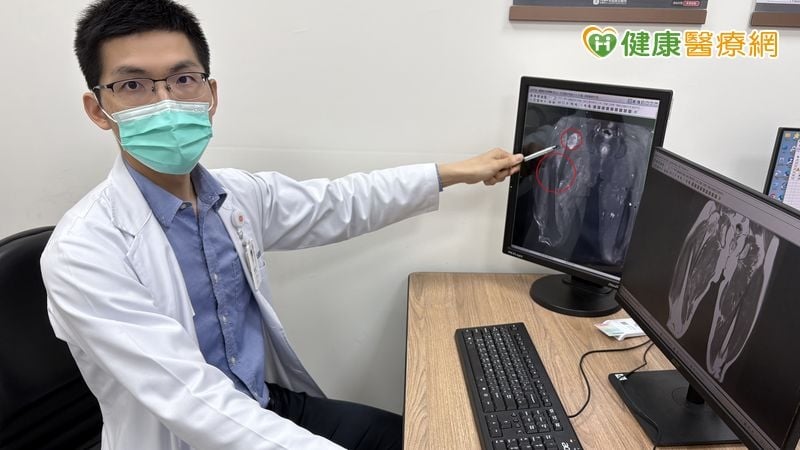 滑雪跌倒意外發現6公分骨腫瘤！醫提醒：夜間疼痛、持續腫脹是警訊