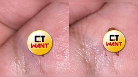 男友喉嚨卡3天咳出「詭異生物」嚇壞　全網見畫面抖爆：不如不知道