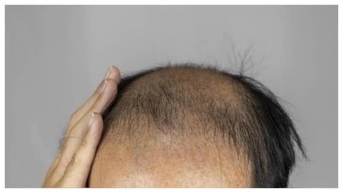 2026新潮「皮克敏」竟成防禿頭神器？醫揭「1關鍵」：改善落髮！