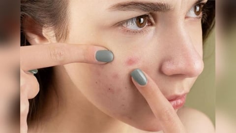 顛覆印象！30至49歲冒「青春痘」最慘　元凶並非臉洗不乾淨