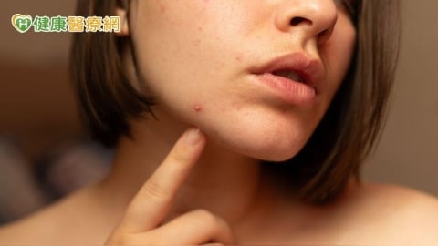 不只青春期！醫：痘痘也困擾上班族、更年期婦女　研究揭僅3成就醫