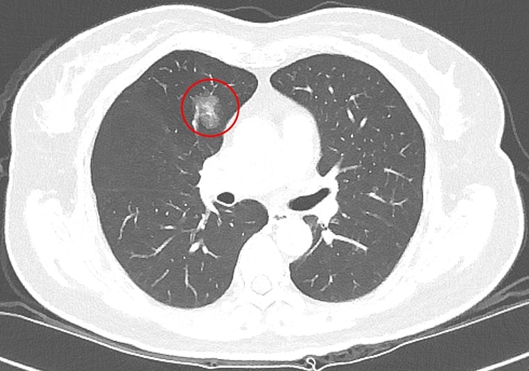 肺小結節影像病理判斷有挑戰！ 研究：約2/3惡性腫瘤