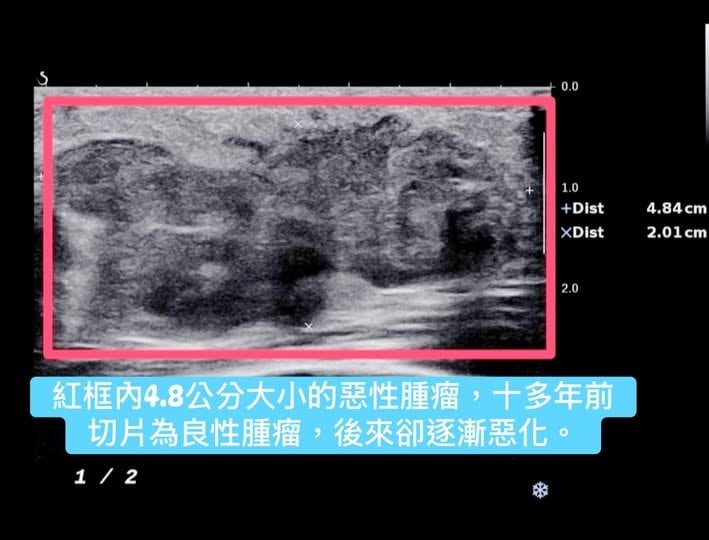 她高中切片良性多年後竟成「雞蛋大腫瘤」！醫示警「別輕忽快檢查」