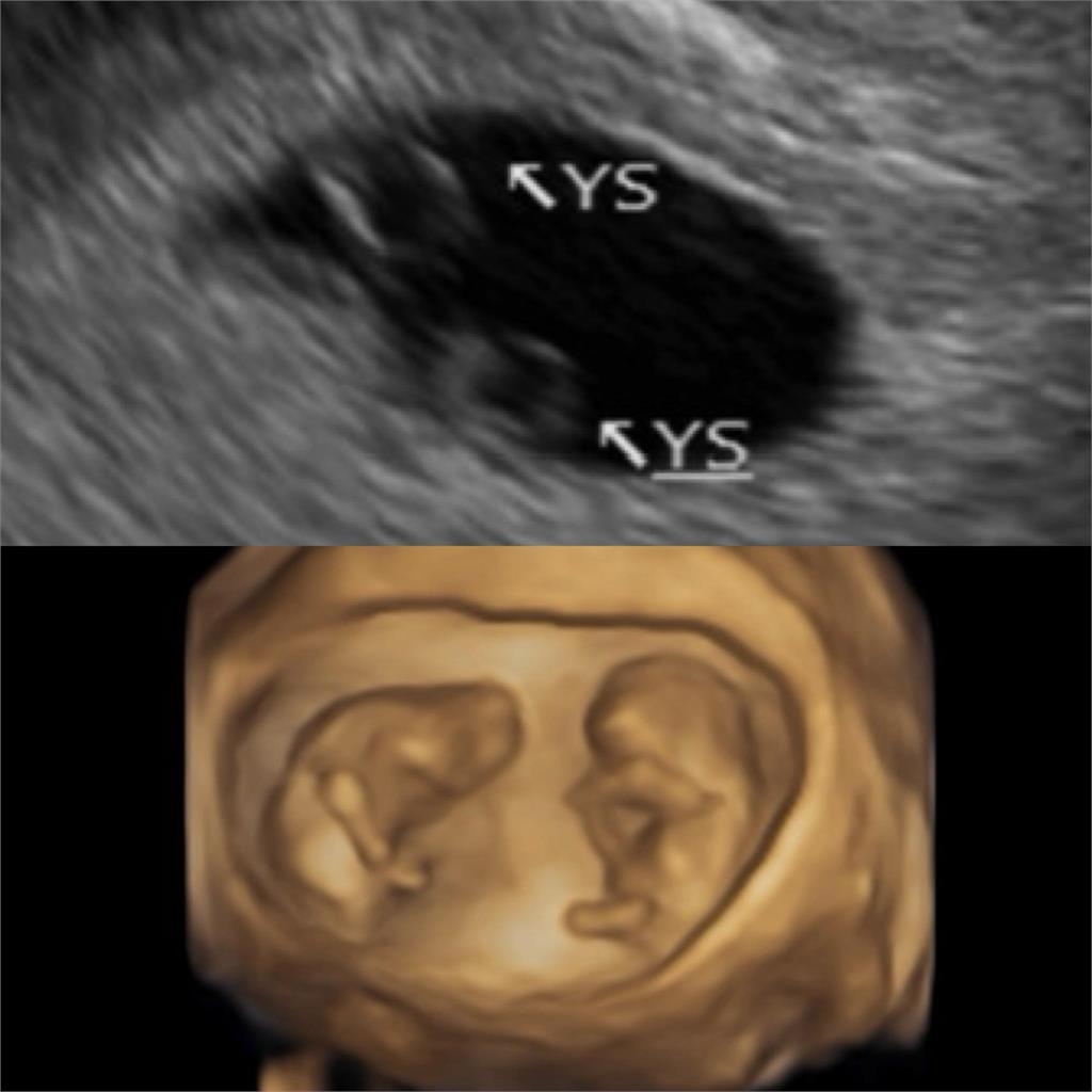 鄭家純流產後曬超音波照傳好消息！「1次+2」懷孕週數曝光了