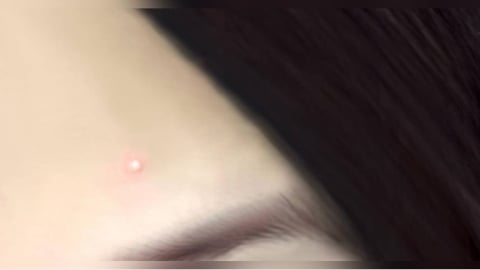 痘痘貼用錯更慘！　醫列「3種痘痘」不適合貼：恐讓發炎升級