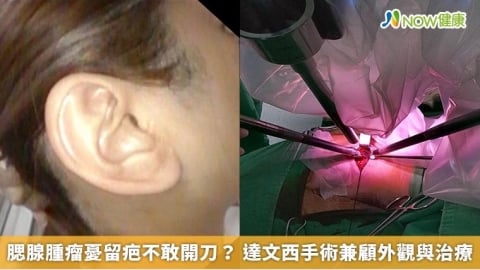 腮腺腫瘤憂留疤不敢開刀？ 達文西手術兼顧外觀與治療