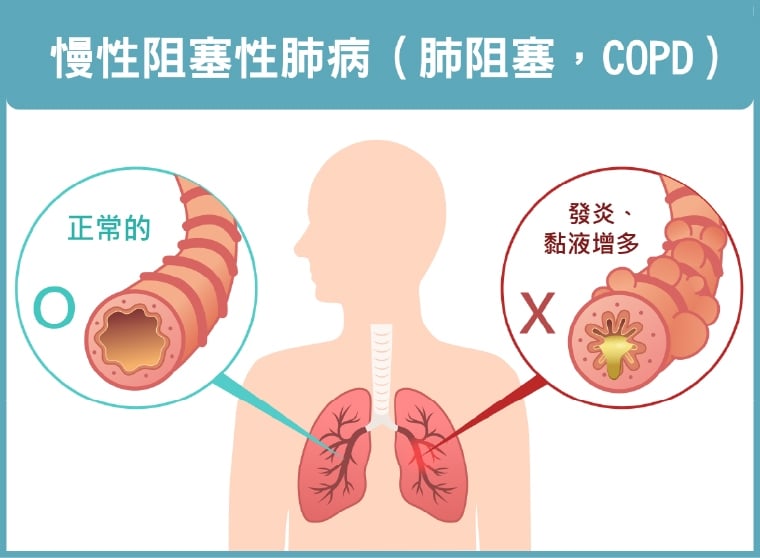 肺阻塞有4種共病！「咳、痰、喘」 3大症狀應提高警覺