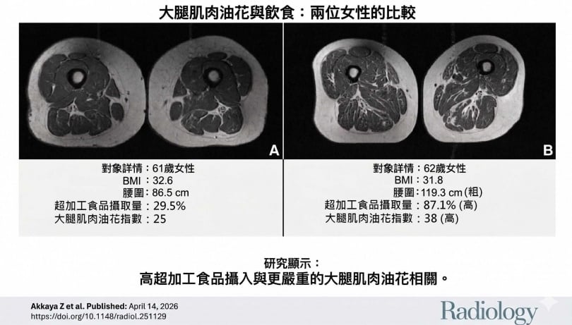 最新研究顯示，攝取超加工食品越多，大腿肌肉脂肪浸潤就越明顯。（圖／翻攝自臉書／蔡明劼醫師 健康。瘦身）
