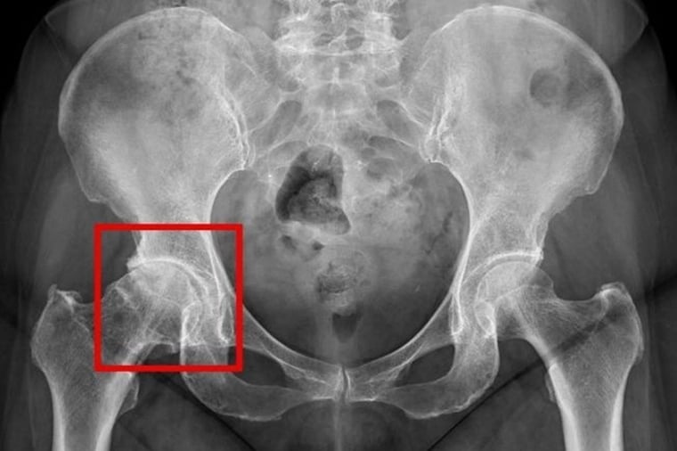 下背僵硬、疼痛不一定是老化！ 當心退化性關節炎警訊