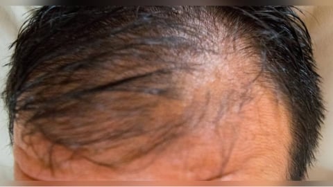 狂吃蛋能生髮？男每天吞3顆生蛋救髮際線　醫示警：結果恐更慘