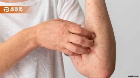 北市高中爆水痘群聚感染！8人疑染病竟讓家長投票決定停課