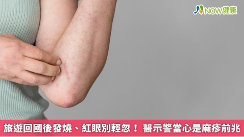 旅遊回國後發燒、紅眼別輕忽! 醫示警當心是麻疹前兆