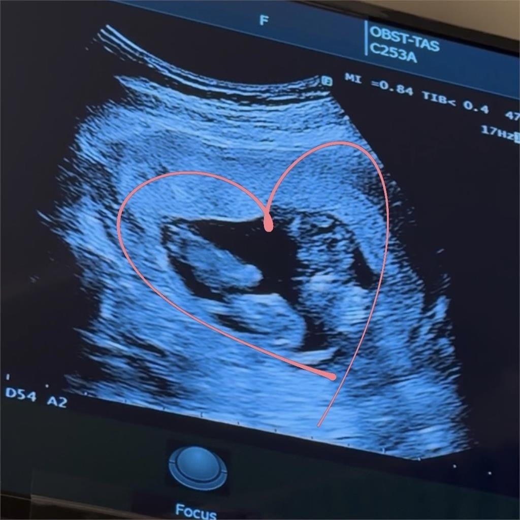 鄭家純懷雙胞胎挺12週孕肚自曝「1害羞變化」！自嘲「2朵花」已凋零