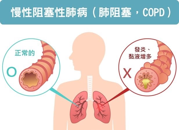 慢性阻塞性肺病未被診斷率高達四到八成！出現「咳、痰、喘」就該當心