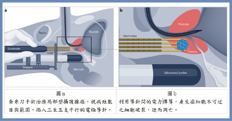 局部型攝護腺癌精準治療！ 北榮引進奈米刀助保護神經