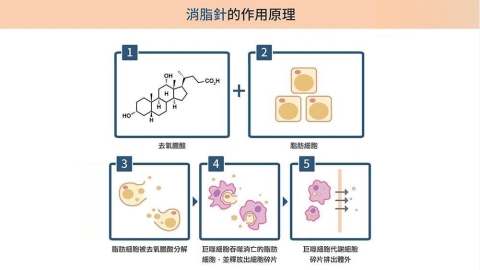 雙下巴改善方式受關注:消脂針與 ONDA超微波成輪廓 管理選擇之一