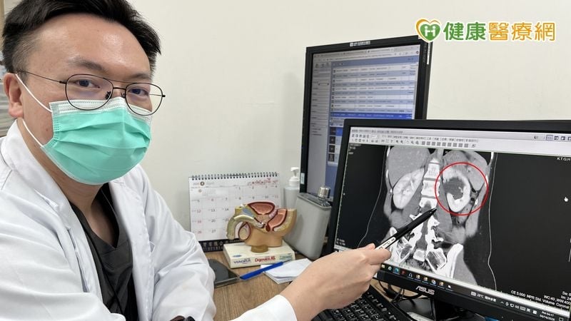 巧克力囊腫復發導致腎水腫　醫療團隊聯手成功保腎