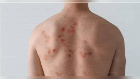 中部男赴日旅遊染麻疹！274人遭匡列　疾管署揭日本6地疫情最嚴峻