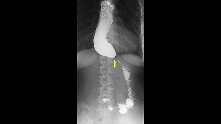 進食後胸悶卡卡找不出病因！ 醫揪罕見食道遲緩不能症