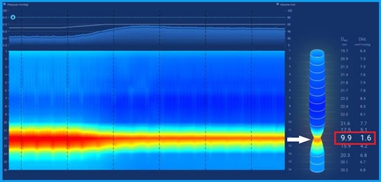 進食後胸悶卡卡找不出病因！ 醫揪罕見食道遲緩不能症