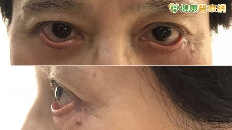 眼整形術後乾眼、閉眼困難？醫說明多元重建對策　眼部結構修復是關鍵