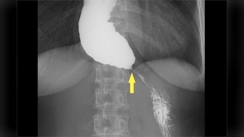 她一吃東西就胸悶竟是罕病！   「鳥嘴狀食道」卡住食物