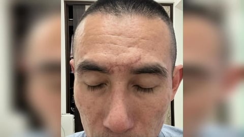 獨家／玩滑車額頭撞地縫10針 男恐終身留疤控園方已讀不回